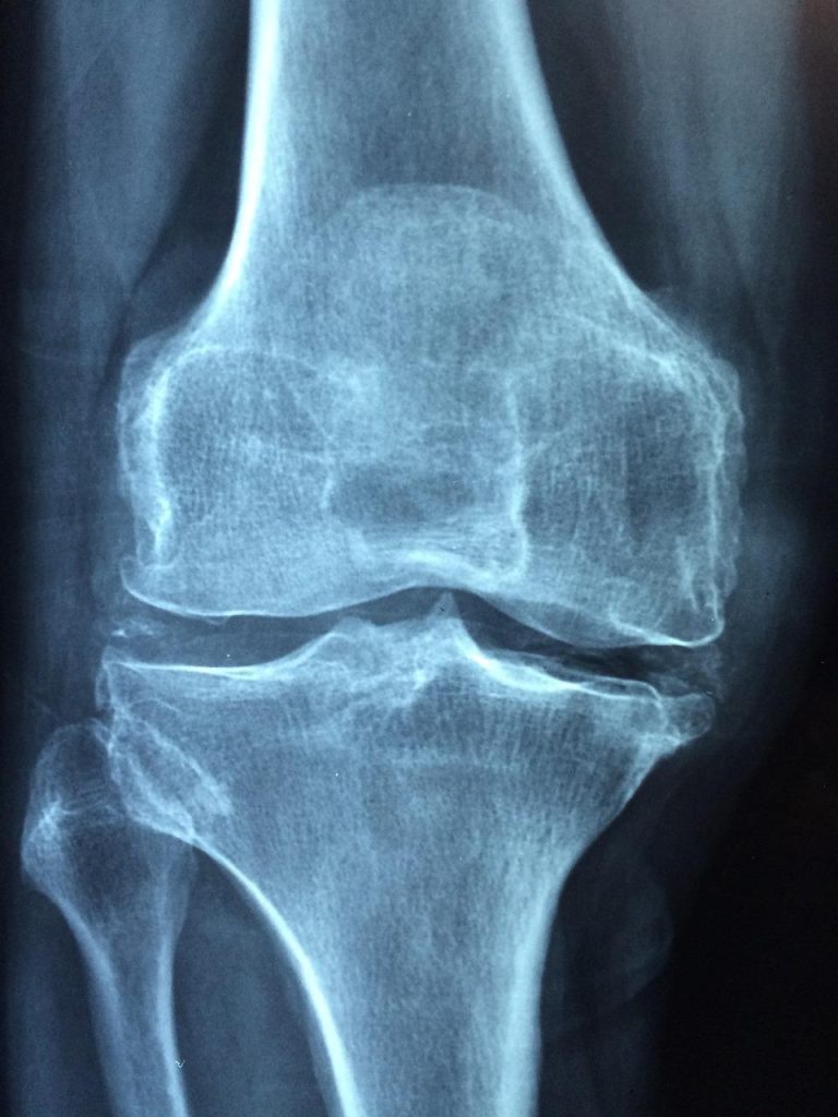 Chiropractor Veenendaal behandelt gewrichtspijn en rugpijn met gespecialiseerde manipulaties voor betere mobiliteit